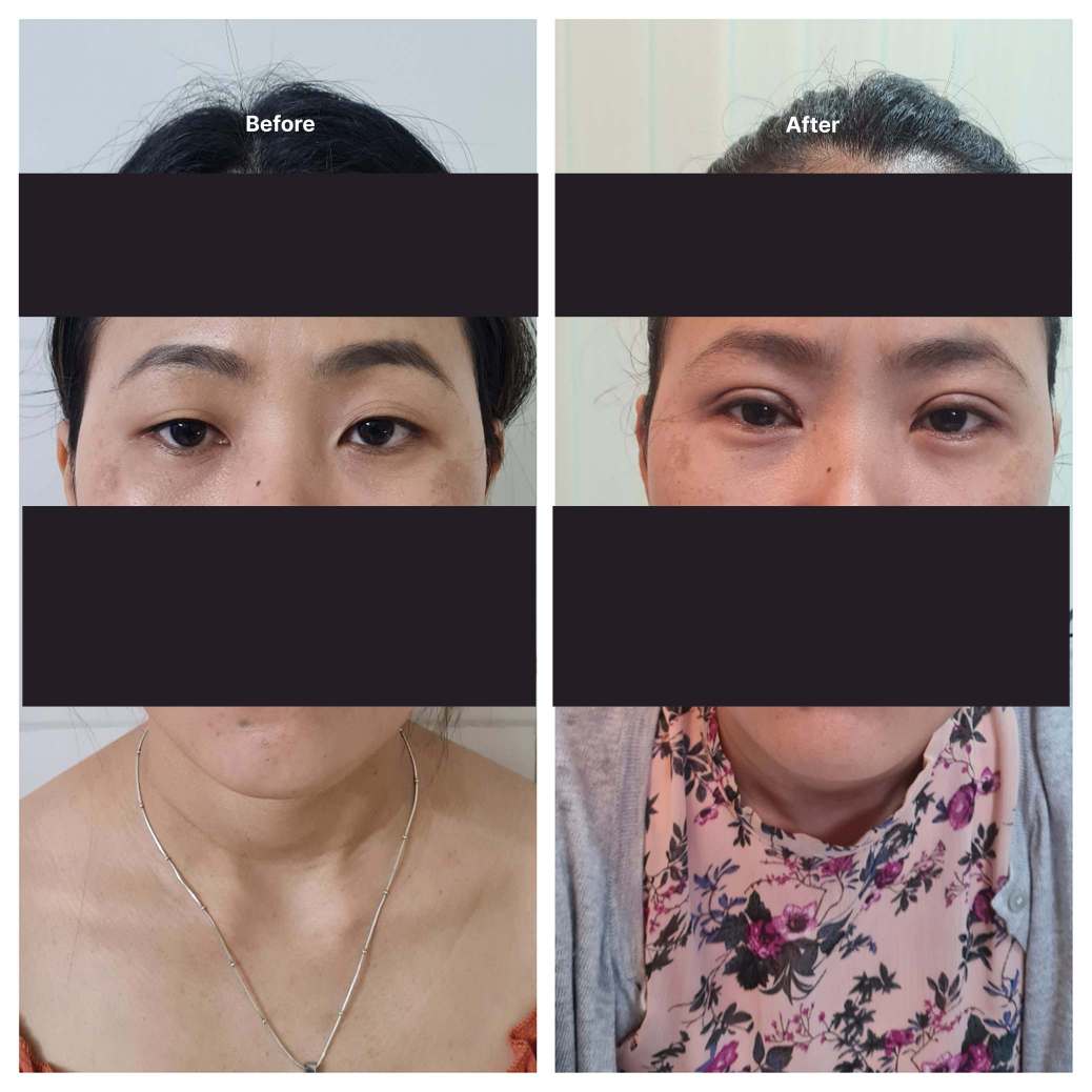 Eyelid Surgery KOQ10
